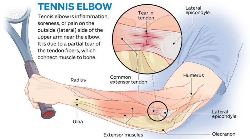How To Get Rid Of Tennis Elbow F