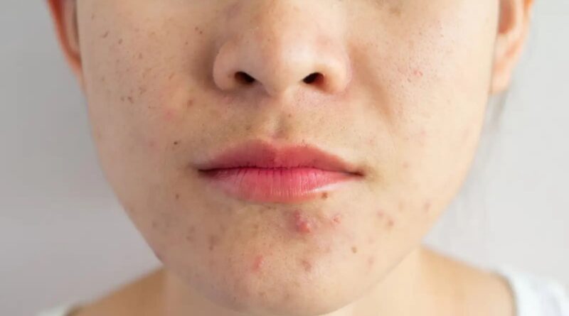 5 truques de cuidados com a pele para combater a acne durante a mudança de estação